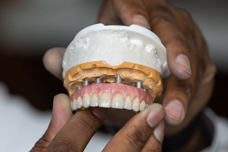 dentist holding upper jaw dental implant model