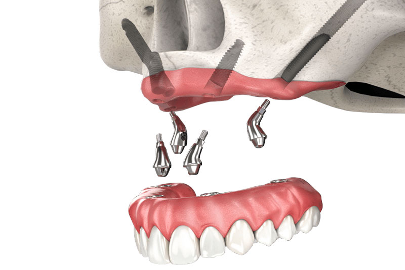 zygomatic dental implant